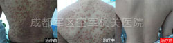 银屑病能根治吗
